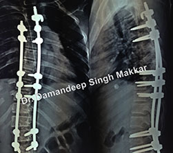 orthopedic spine surgeon case study treatment in Punjab hospital
