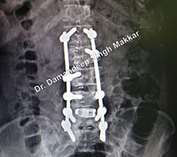 lumbar spine fusion surgery performed by Dr Makkar in Ludhiana