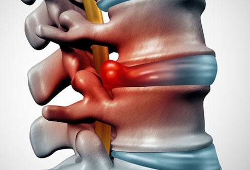 prolapsed disc slip disc treatment in Ludhiana spine hospital